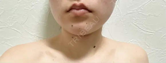 ボトックス（エラ・小顔） / ボトックス（肩） アリエル美容クリニック 水戸院 DAY 6 メイン用