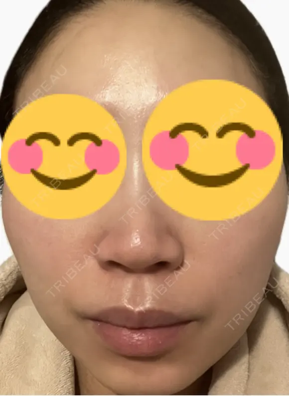 ルメッカ La Fee Clinic DAY 4 メイン用