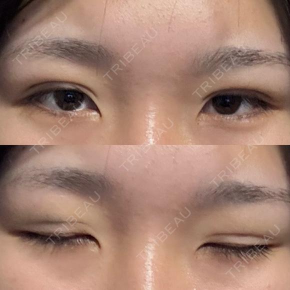二重埋没 湘南美容クリニック 千葉センシティ院 DAY 0 メイン用