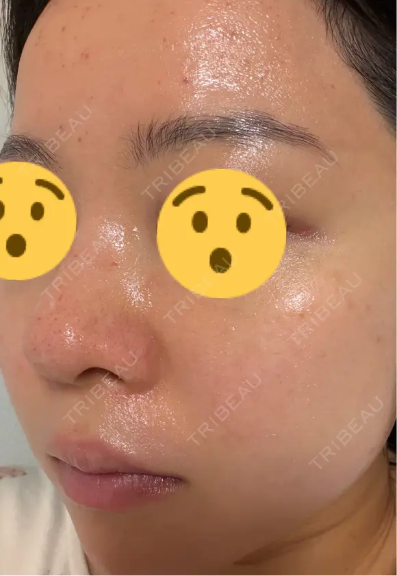 ニードルRF（ポテンツァなど） エトワールレジーナクリニック新宿院 DAY 2 メイン用