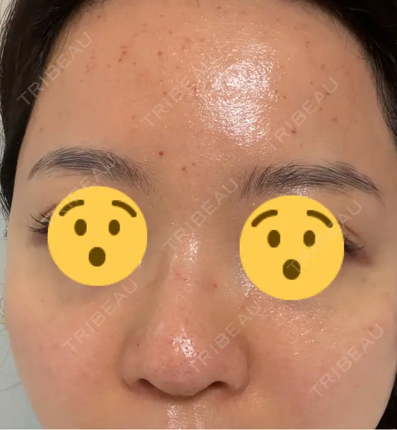 ニードルRF（ポテンツァなど） エトワールレジーナクリニック新宿院 DAY 2 メイン用