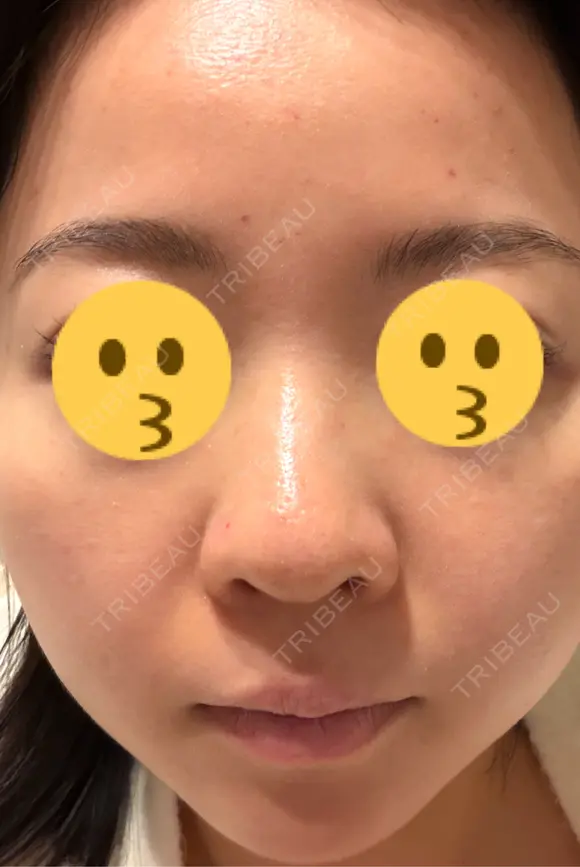 ニードルRF（ポテンツァなど） エトワールレジーナクリニック新宿院 DAY 3 メイン用