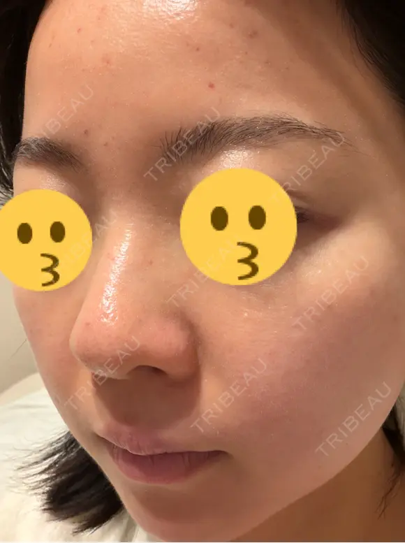 ニードルRF（ポテンツァなど） エトワールレジーナクリニック新宿院 DAY 3 メイン用