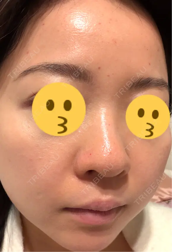 ニードルRF（ポテンツァなど） エトワールレジーナクリニック新宿院 DAY 3 メイン用