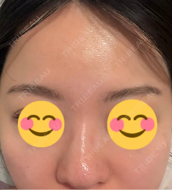 ニードルRF（ポテンツァなど） エトワールレジーナクリニック新宿院 DAY 6 メイン用