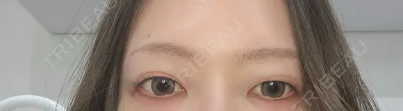 ヒアルロン酸注入（涙袋） ルラ美容クリニック 高田馬場院 DAY 55 メイン用