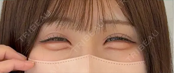 ヒアルロン酸注入（涙袋） アリエル美容クリニック 横浜院 DAY 8 メイン用