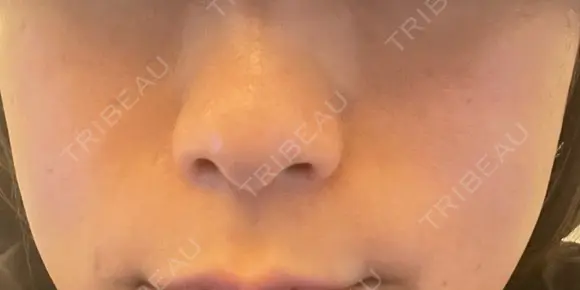 ヒアルロン酸注入（頬） 目白ホワイトクリニック AFTER メイン用