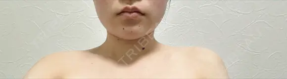 ボトックス（エラ・小顔） / ボトックス（肩） アリエル美容クリニック 水戸院 DAY 7 メイン用