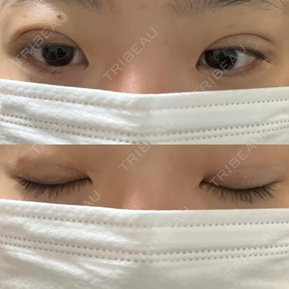 二重埋没 湘南美容クリニック 千葉センシティ院 DAY 5 メイン用