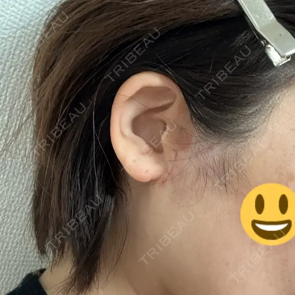 切開リフト GRACY TOKYO CLINIC【グレイシートウキョウクリニック】 DAY 10 メイン用