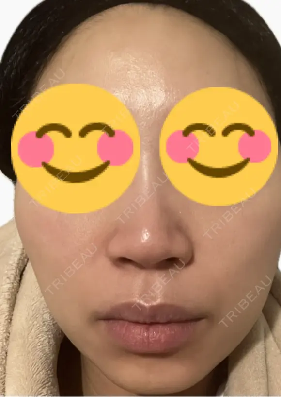 ルメッカ La Fee Clinic DAY 6 メイン用