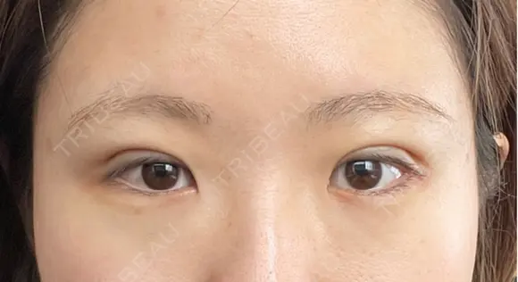 二重埋没 アリエル美容クリニック 郡山院 DAY 5 メイン用
