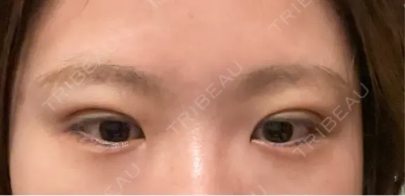 二重埋没 アリエル美容クリニック 郡山院 DAY 6 メイン用