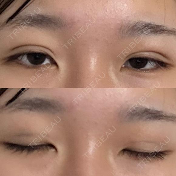 二重埋没 湘南美容クリニック 千葉センシティ院 DAY 1 メイン用