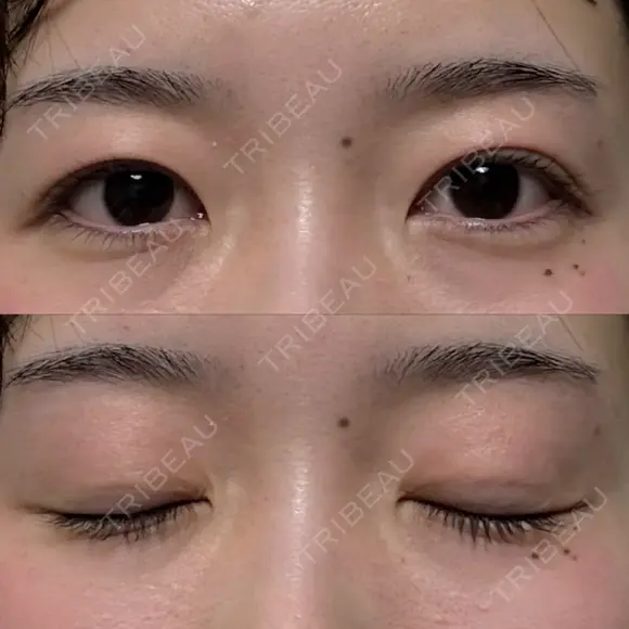 二重埋没 / 自然癒着法 シンデレラ＆ダヴィンチクリニック AFTER メイン用
