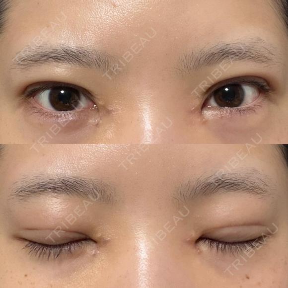 二重埋没 / 目頭切開 / 上まぶたの脂肪取り / ヒアルロン酸注入（涙袋） アリエル美容クリニック 郡山院 DAY 21 メイン用