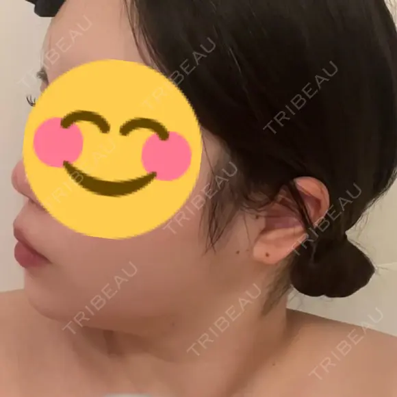 二重埋没 / 脂肪吸引（顔） ルラ美容クリニック 名古屋本院 DAY 13 メイン用