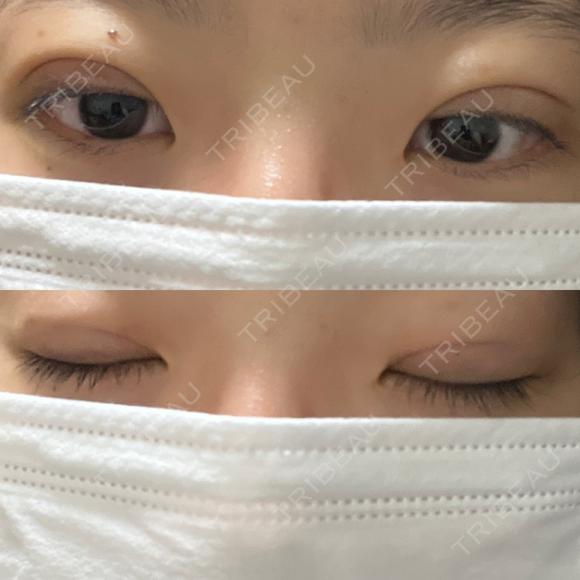 二重埋没 湘南美容クリニック 千葉センシティ院 DAY 7 メイン用