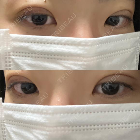 二重埋没 湘南美容クリニック 千葉センシティ院 DAY 7 メイン用