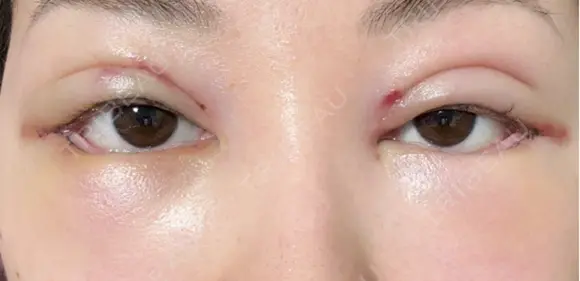 二重埋没 / 目尻切開 / タレ目形成・グラマラスライン（切開） / 自然癒着法 Stand by Beauty Clinic DAY 1 メイン用