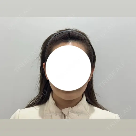 脂肪吸引（顔） HAAB BEAUTY CLINIC 南青山本院（新院） DAY 28 メイン用