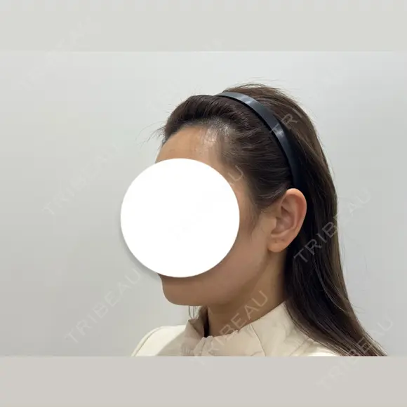 脂肪吸引（顔） HAAB BEAUTY CLINIC 南青山本院（新院） DAY 28 メイン用