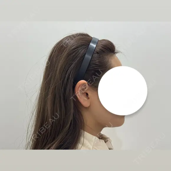 脂肪吸引（顔） HAAB BEAUTY CLINIC 南青山本院（新院） DAY 28 メイン用