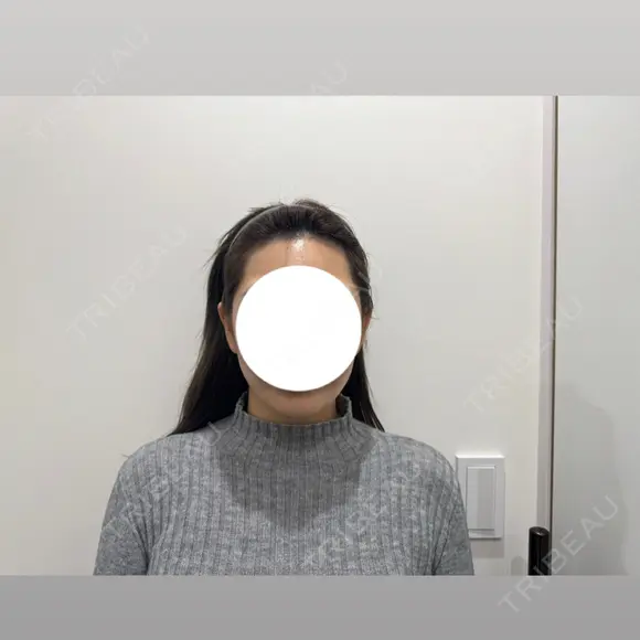脂肪吸引（顔） HAAB BEAUTY CLINIC 南青山本院（新院） AFTER メイン用