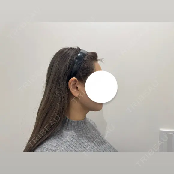 脂肪吸引（顔） HAAB BEAUTY CLINIC 南青山本院（新院） DAY 90 メイン用