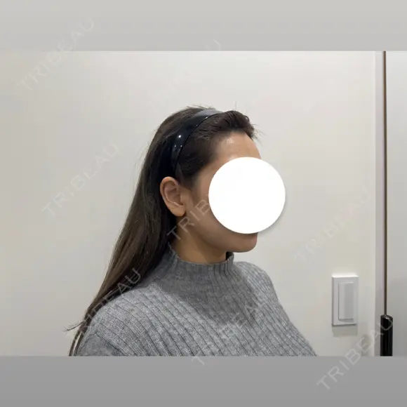 脂肪吸引（顔） HAAB BEAUTY CLINIC 南青山本院（新院） DAY 90 メイン用