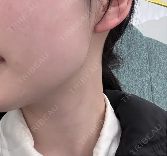 オンダリフト HAAB CLINIC 池袋院 DAY 0 メイン用