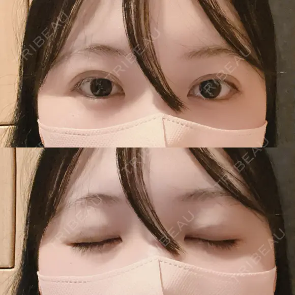 二重埋没 アリエル美容クリニック 横浜院 DAY 0 メイン用