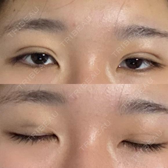 二重埋没 湘南美容クリニック 千葉センシティ院 DAY 2 メイン用