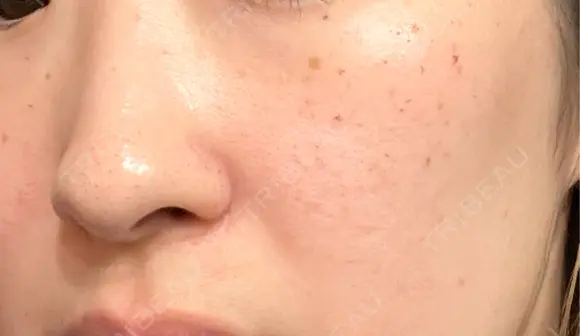 ルメッカ / LDM・インテンスウルトラ Chloe Cheongdam Clinic （クロエチョンダムクリニック） DAY 2 メイン用