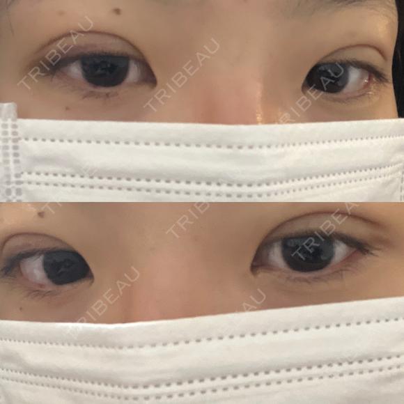 二重埋没 湘南美容クリニック 千葉センシティ院 DAY 8 メイン用