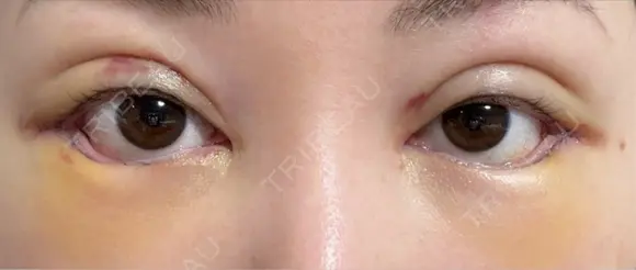 二重埋没 / 目尻切開 / タレ目形成・グラマラスライン（切開） / 自然癒着法 Stand by Beauty Clinic DAY 2 メイン用