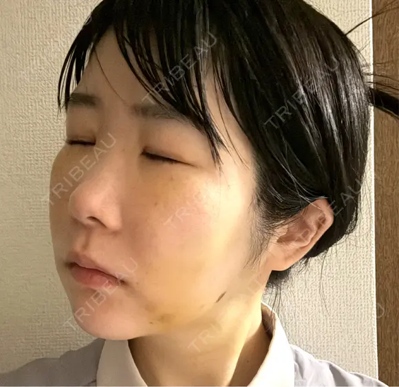 糸リフト / クマ治療 / バッカルファット除去 / 脂肪吸引（顔） / ジョールファット除去 / ネックリフト BLINC CLINIC （ブリンク クリニック） DAY 6 メイン用