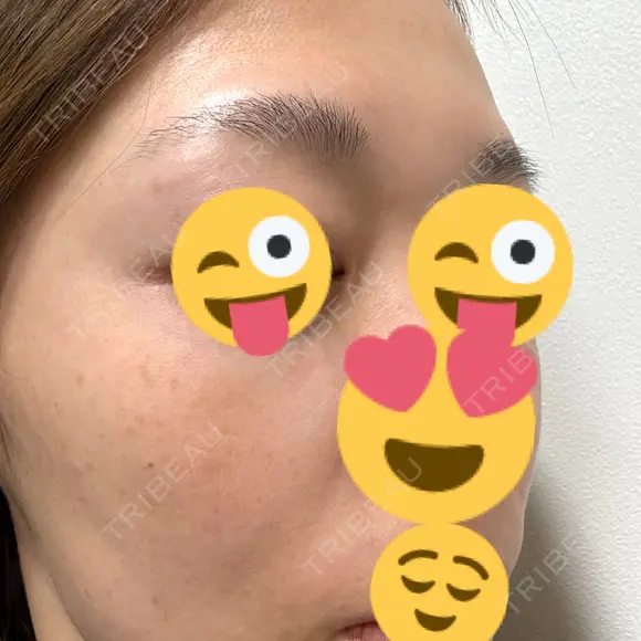 ピコレーザートーニング（美白・肝斑） / レーザートーニング（美白・肝斑） KARIS beauty clinic AFTER メイン用