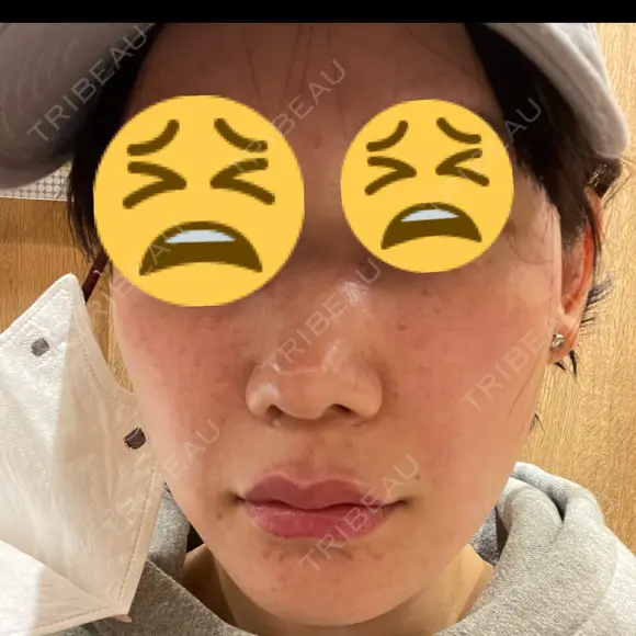 肌育注射（ジュベルックなど） メディアージュクリニック 大阪梅田院 DAY 0 メイン用