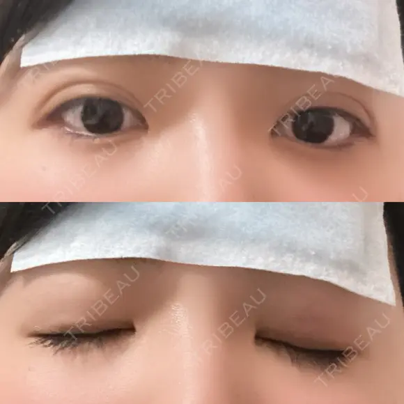 二重埋没 アリエル美容クリニック 横浜院 DAY 1 メイン用