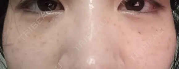 ルメッカ やさしい美容皮膚科・皮フ科　秋葉原院 DAY 0 メイン用