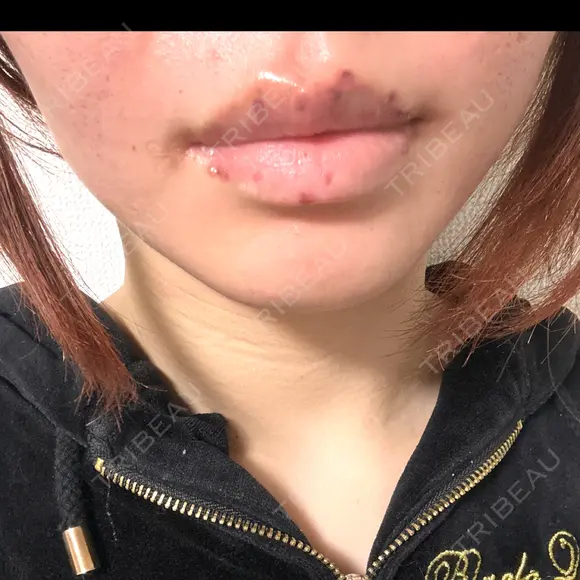 シミ取りレーザー 新宿美容外科クリニック 新宿院 DAY 0 メイン用