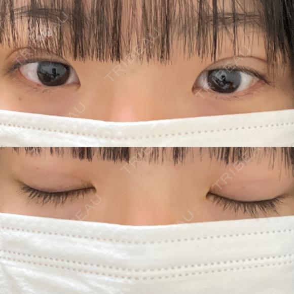 二重埋没 湘南美容クリニック 千葉センシティ院 DAY 8 メイン用