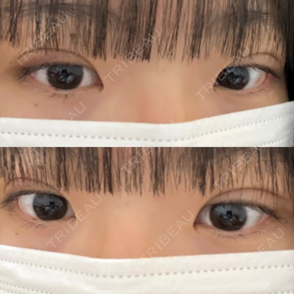 二重埋没 湘南美容クリニック 千葉センシティ院 DAY 8 メイン用