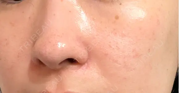 ルメッカ / LDM・インテンスウルトラ Chloe Cheongdam Clinic （クロエチョンダムクリニック） DAY 3 メイン用