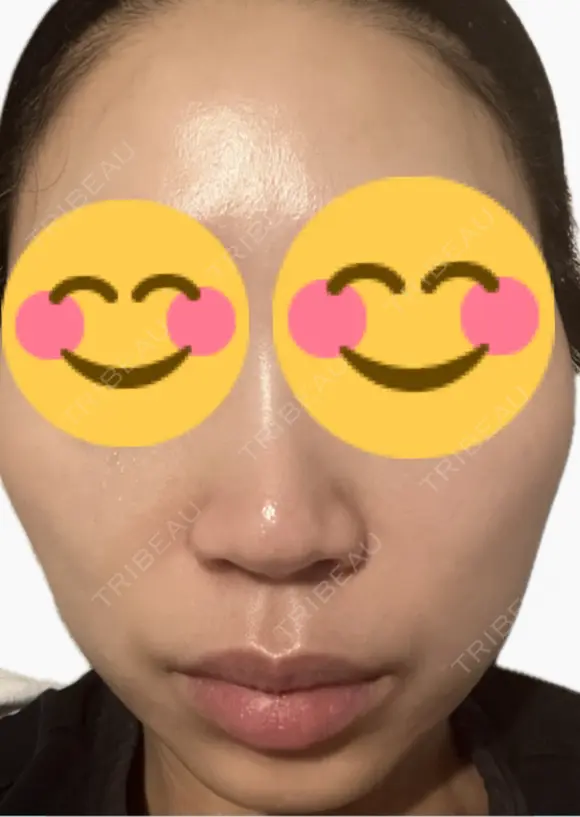 ルメッカ La Fee Clinic AFTER メイン用