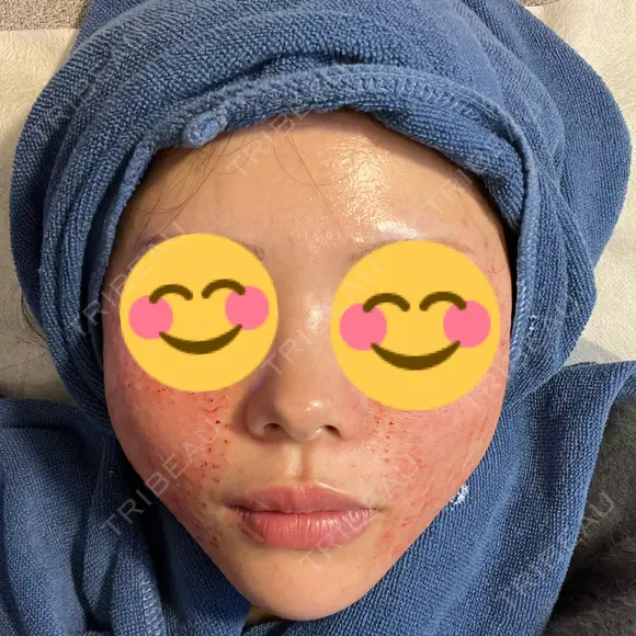 水光注射（ハリ・美肌） REVI CLINIC銀座院  DAY 0 メイン用