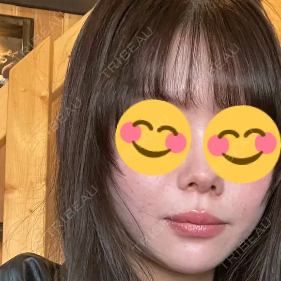 水光注射（ハリ・美肌） REVI CLINIC銀座院  DAY 1 メイン用