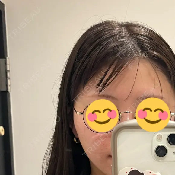 水光注射（ハリ・美肌） REVI CLINIC銀座院  DAY 3 メイン用
